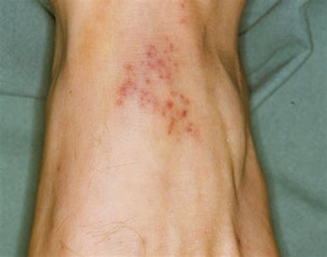 Petechial Rash Causes Pictures Symptoms Treatment In