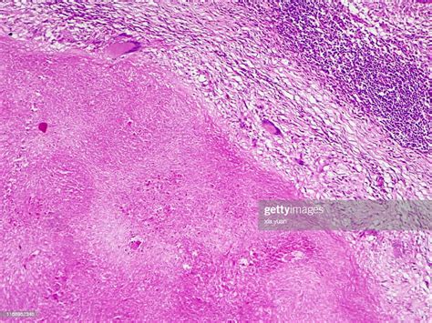Caseous Necrosis Of Lymphatic Node10x Light Micrograph High Res Stock