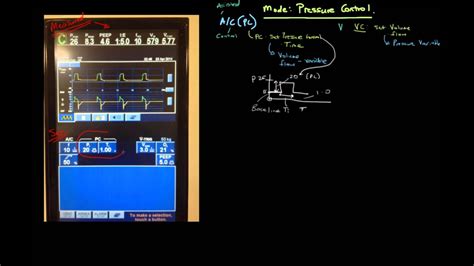 Principles Of Mechanical Ventilation 11 Modes Pressure Control Youtube