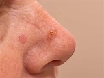 Actinic Keratosis - Symptoms, Causes, Treatment, And Cost