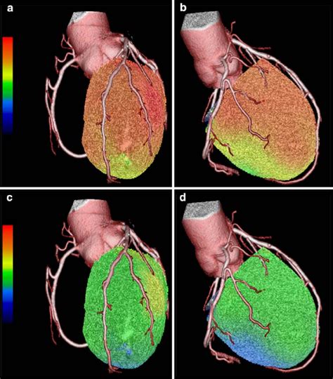Three Dimensional Cardiac Hybrid Pet Ct Images Of Patient With Angina