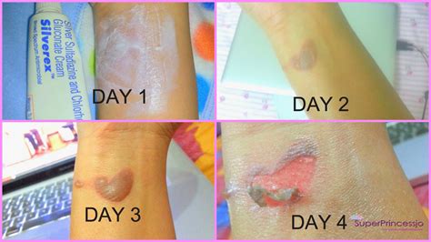 How To Cover A Burn Blister With Makeup Mugeek Vidalondon