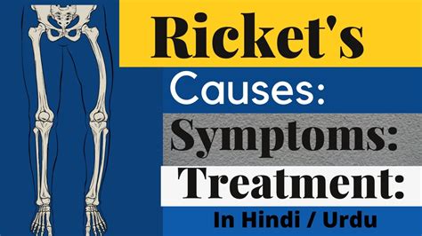 What Is Rickets Osteomalacia Causes Sign And Symptoms Diagnosis