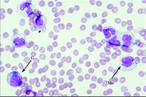 Peripheral Blood Fi Lm Of Patient 2 Showing Immature Granulocytes G