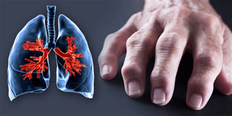 Effects Of Rheumatoid Arthritis On Lungs You Were Not Aware Of