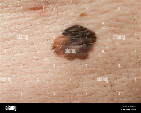 A Large Mole On A Mans Back Exhibiting Signs Of Melanoma Later