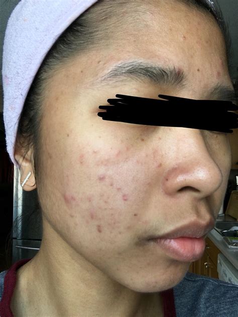 Sudden Breakout Started At Nov2018 Acne