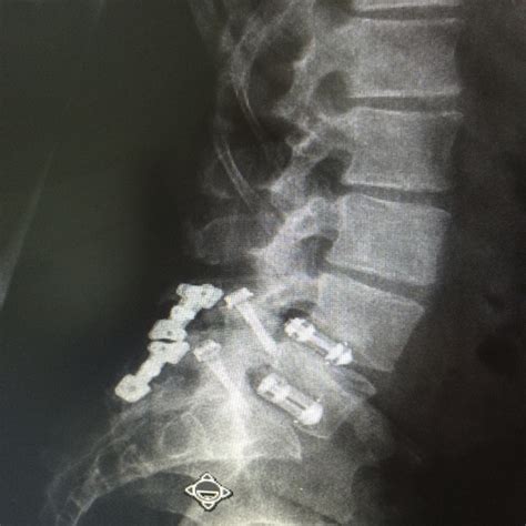 Revision Spinal Fusion Surgery Doctorvisit