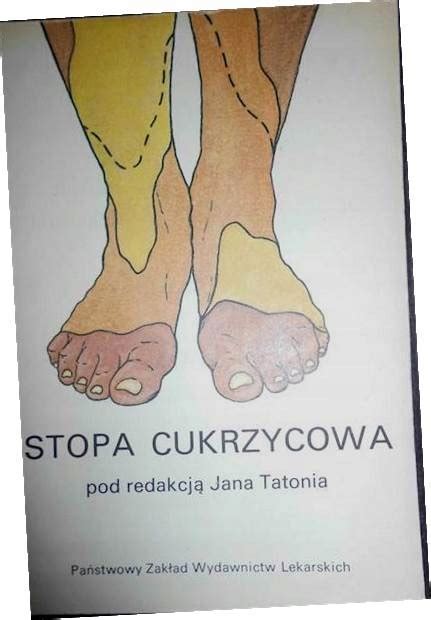 Stopa Cukrzycowa Jan Tatoń 12660620533 Książka Allegro