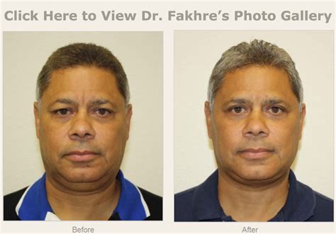 Male Facelift Wesley Chapel Fl New Tampa Plastic Surgery