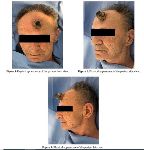 Frontal Horn A Cutaneous Squamous Cell Carcinoma Of The Forehead Area