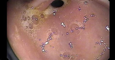 Ms is an inflammatory disease that causes damage to the central nervous system. Symptoms of Leaky Gut (Slideshow)