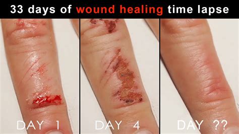 33 Days Of Wound Healing Timelapse Healing Timelapse Compilations