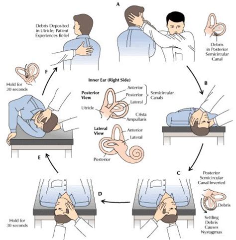 √ Epleys Maneuver Modified Epleys Left It Is Also Known As The Physical Therapists Bob