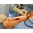 Tendon Rupture  The Foot And Ankle Online Journal