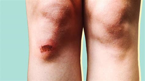 What Causes Cellulitis—and How Can You Protect Yourself