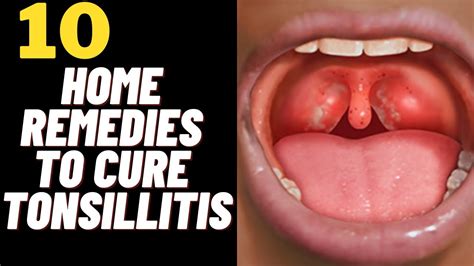 10 Home Remedies To Cure Tonsil Stones And Tonsillitis Fast Youtube