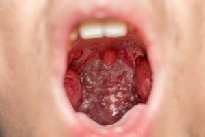 Tonsil stone symptoms and treatment. ear, nose and throat journal: Swollen uvula after drinking, smoking, and vomiting