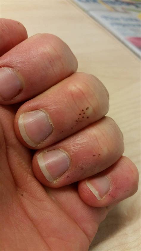 What Do Little White Dots On Your Fingernails Mean Design Talk