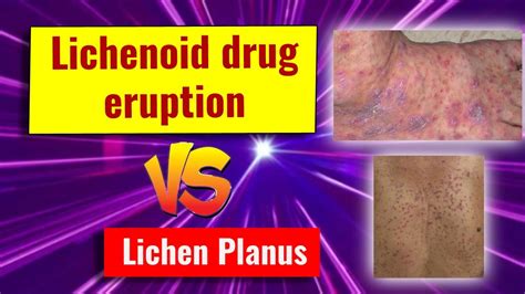 Lichenoid Drug Eruption Features And Comparison With Lichen Planus