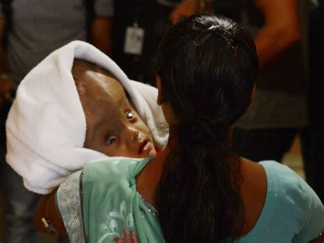 Baby With Swollen Head Discharged From Hospital In India India Gulf