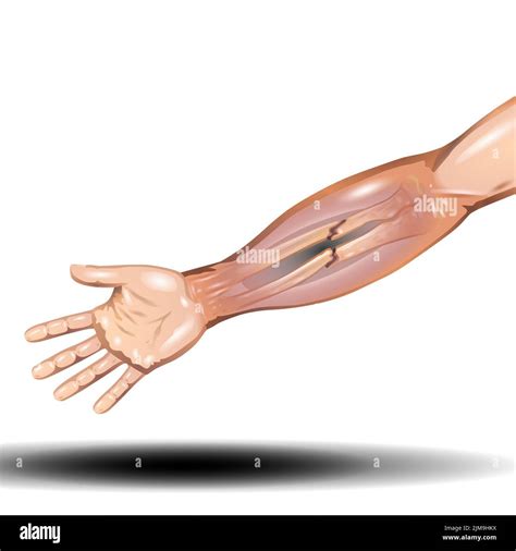 Hand Bone Fracture Distal Radius Fracture And Broken Arm Bone Types