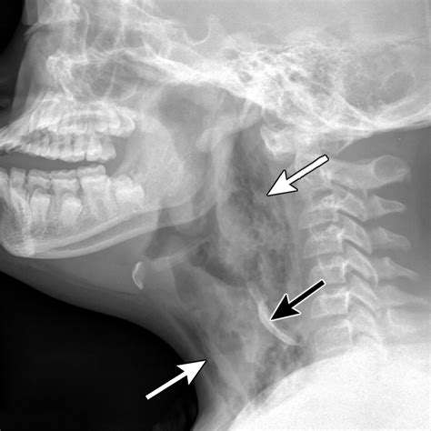 Imaging Acute Airway Obstruction In Infants And Children Radiographics