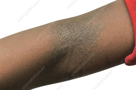 Eczema On The Elbow Stock Image C0103280 Science Photo Library