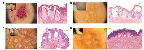Figure 1 From Diagnostic Values Of Dermatoscopy And Cd31 Expression In