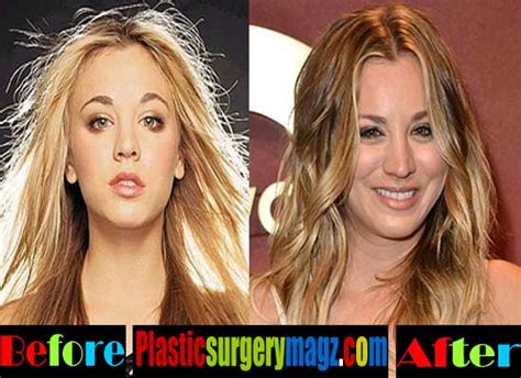 Kaley Cuoco Plastic Surgery Before And After Photos Plastic Surgery