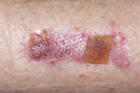 Skin Graft Donor Site On The Thigh Stock Image C0110441 Science