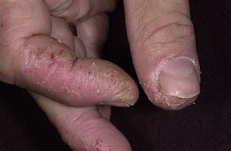 Dry Eczema On Hands Pictures 475 Photos And Images