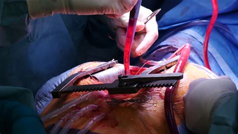 Operation live viewers applauded the 'amazing' surgeons after channel 5 aired an open heart surgery. Open Heart Surgery, Close-up of Stock Footage Video (100% ...