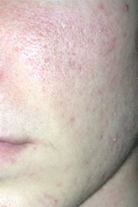 Severe Hyperpigmentation In Need Of Some Tips Or Help Pics