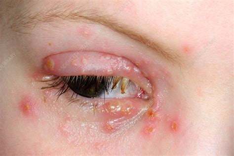Herpes Infection Of The Eyelid Stock Image C013 9706 Science Photo Library