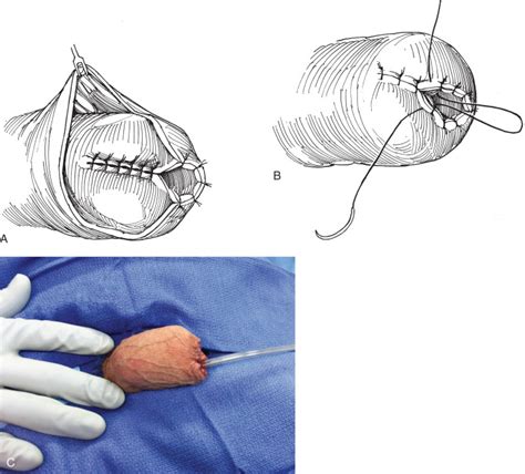 Partial Penectomy Abdominal Key