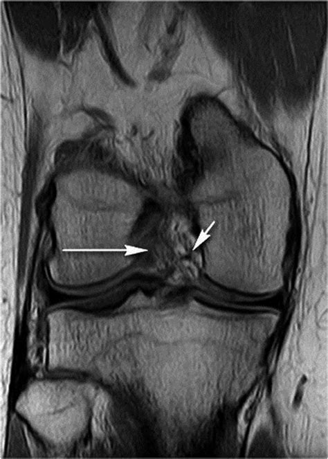 Anterior cruciate ligament tear these pictures of this page are about:mri knee acl tear. A Twenty-nine-Year-Old Woman with a Twisting Injury to the Right Knee - JBJS Image Quiz