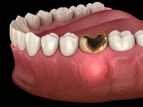 Stages Of An Abscessed Tooth What To Do