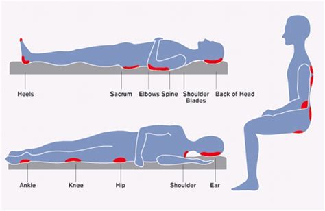 Pressure Ulcer Locations Diagram