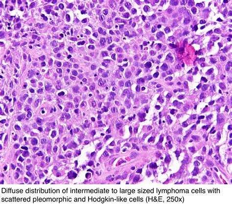 Pathology Outlines Primary Mediastinal Large B Cell Lymphoma Pmbcl