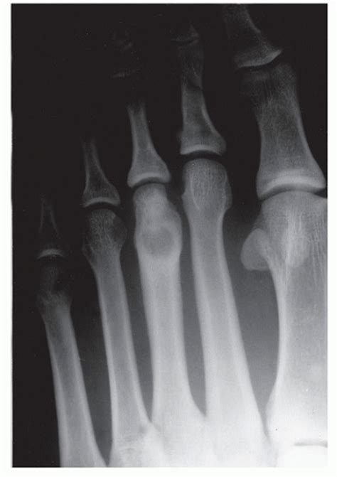 Bone Tumors Of The Foot And Ankle Musculoskeletal Key