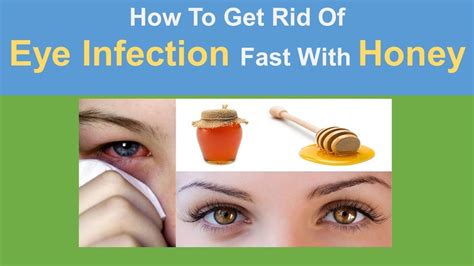 How To Get Rid Of Eye Infection Fast Iy With Honey Diy How To Cure