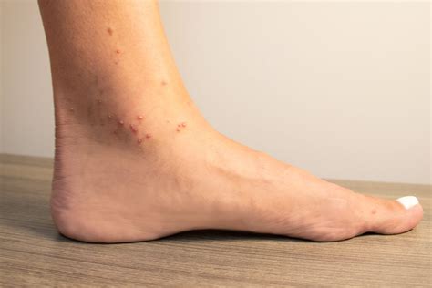 How To Treat Ant Bites · Conway Medical Center