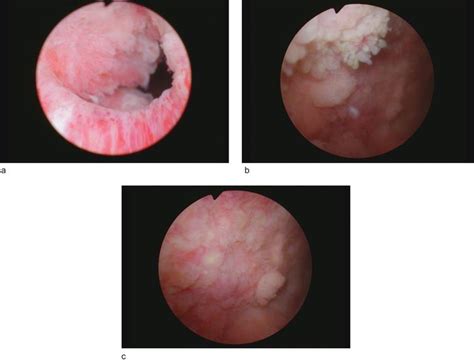 Case Bladder Cancer