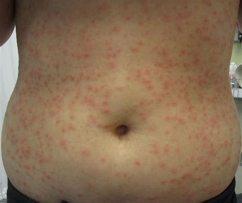 Red Bumps On Skin After Epilation Causes And Sure Solutions