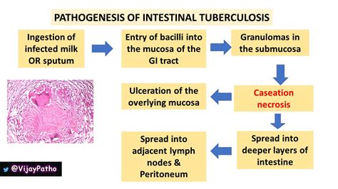 Intestinal Tuberculosis Pathology Made Simple