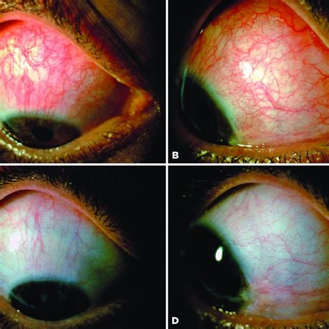 Pdf Nodular Anterior Scleritis Associated With Bergers Disease