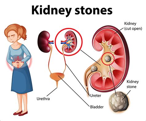 Rirs Surgery For Kidney Stone Removal Urolife Clinic Pune
