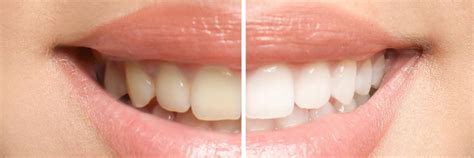 How To Whiten Your Teeth Without Affecting Dental Work Like Crowns