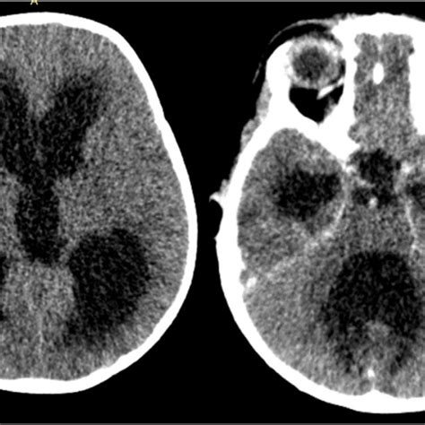 Brain Ct Scan Showing Dilated Fourth Ventricle And Slit Lateral And
